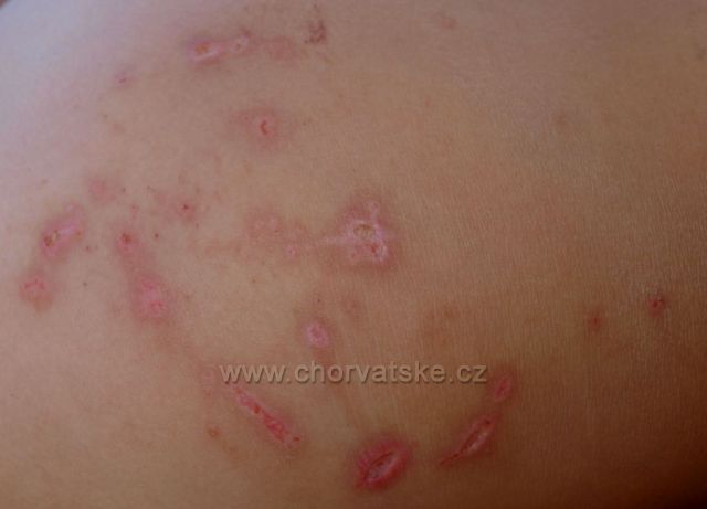 poprhlenie po mesiaci